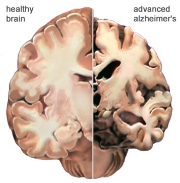 brain